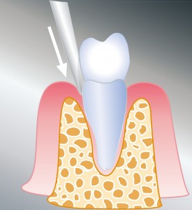 1. Der Fassapparat wird in Höhe des Zahnhalses getrennt. Dadurch wird der Zahn gelockert. 