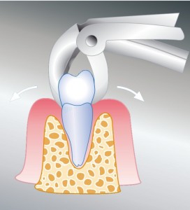 2. Der Zahn wird mit Hilfe einer Zange aus dem Zahnfach entfernt. 